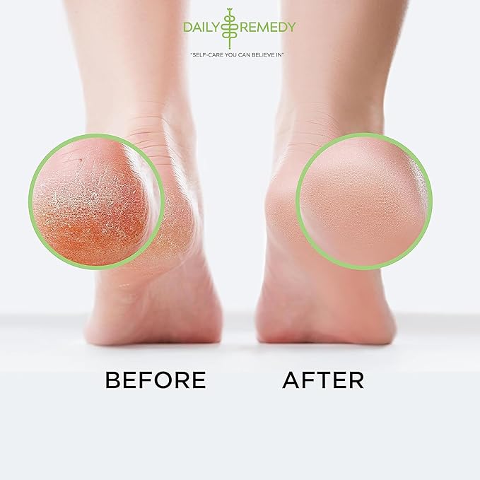 Tea Tree Oil Foot Soak with Epsom Salt - Made in USA - for Toenail irritations, Athletes Foot, Stubborn Foot Odor Scent, Softens Calluses & Soothes Sore Tired Feet - 16 Ounce